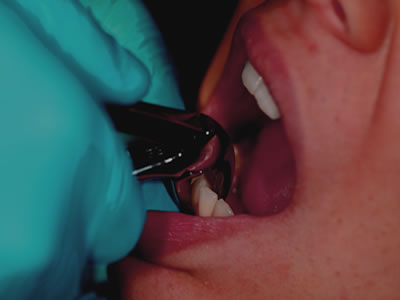 Dental Extrations